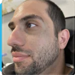 Microneedling treatment at Dripology medspa - photo 2