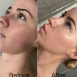 microneedling before after