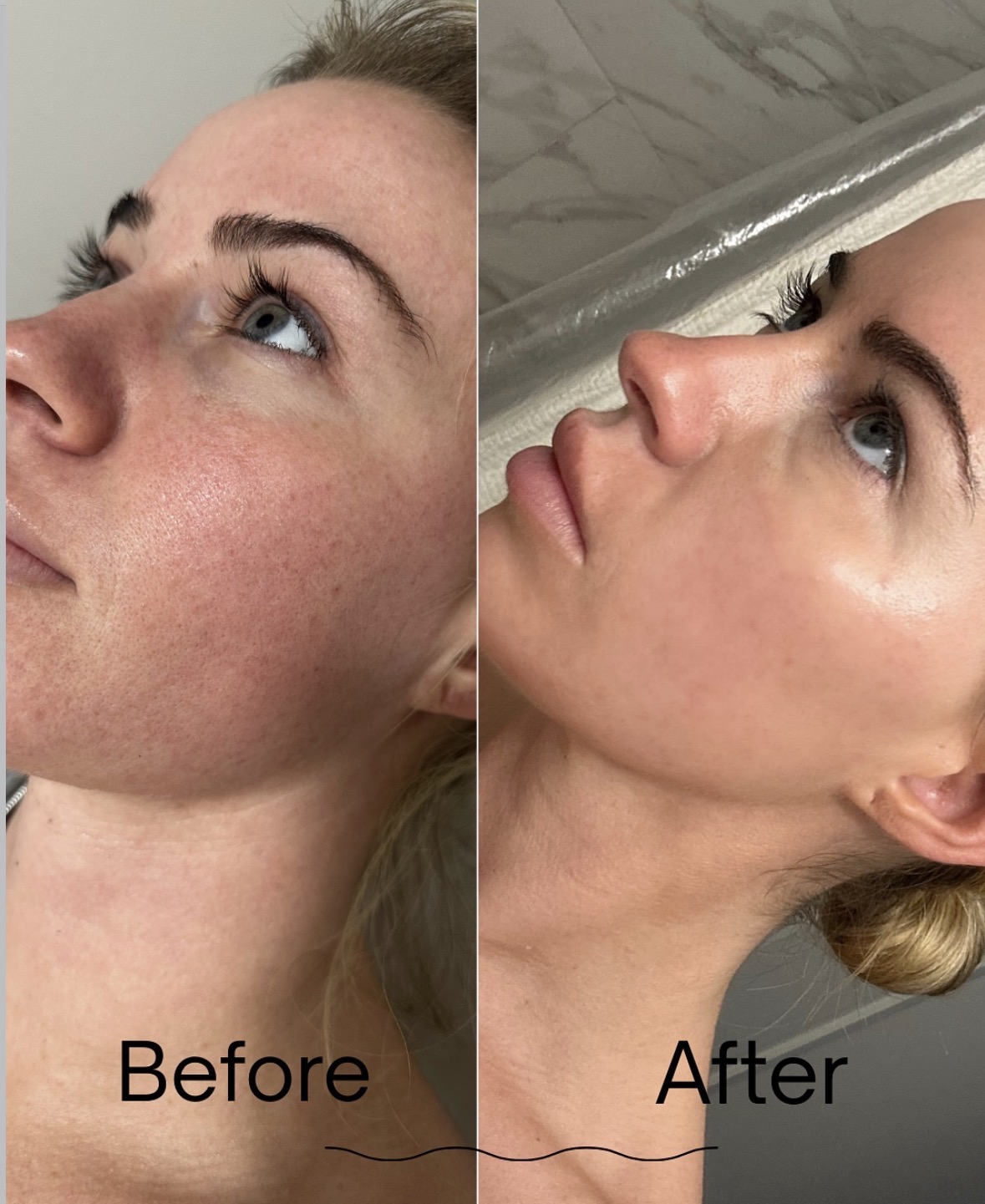 microneedling before after