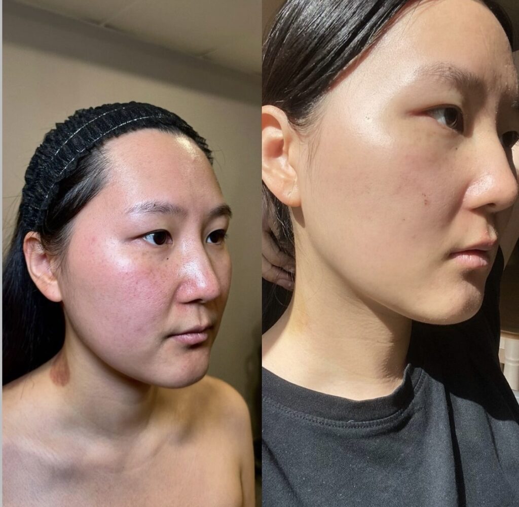 Microneedling before after 2