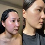 Microneedling before after 2