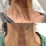 Botox treatment results gallery at Dripology - photo 2