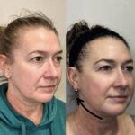 Botox treatment results gallery at Dripology