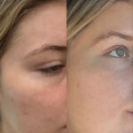 microneedling before after