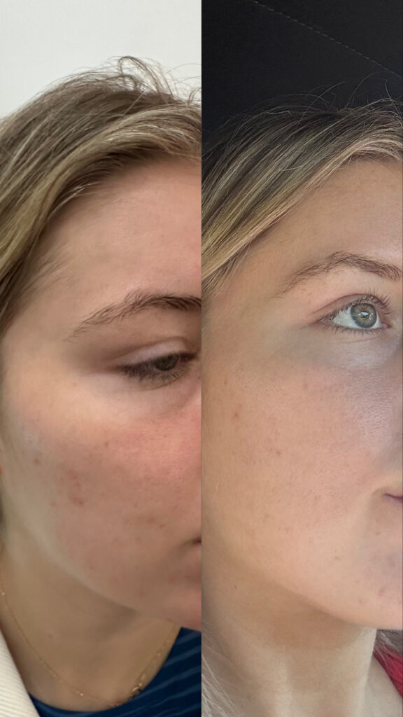 microneedling before after