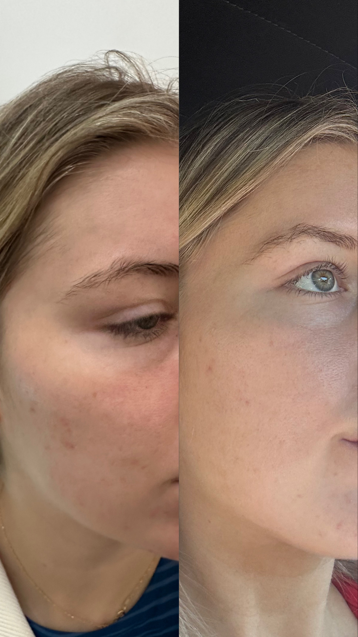 microneedling before after