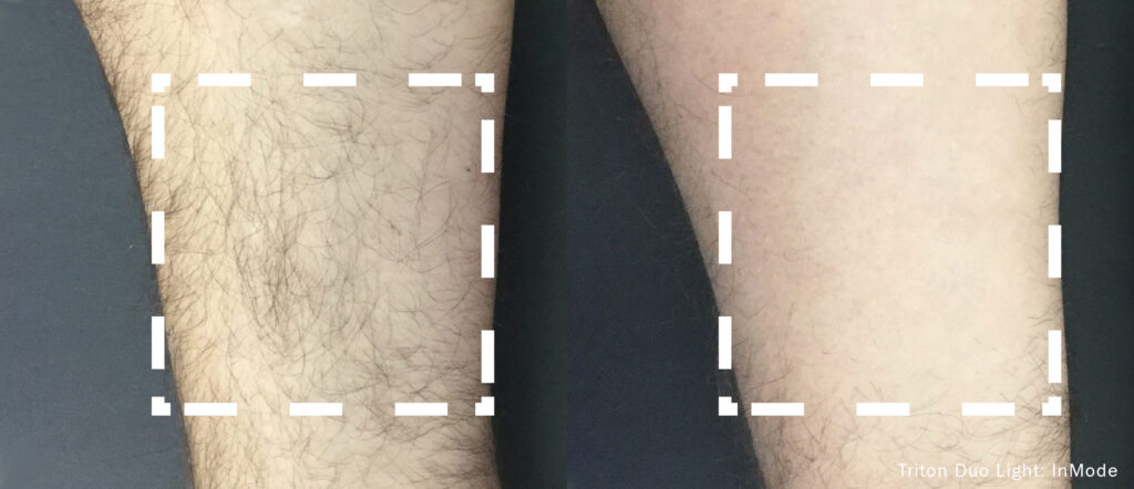 Laser hair removal treatment at Dripology - photo 1