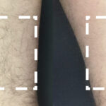 Laser hair removal treatment at Dripology - photo 1