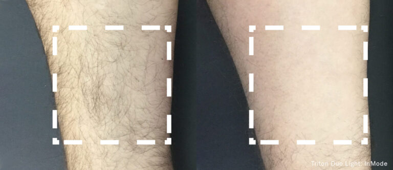 Laser hair removal treatment at Dripology - photo 1