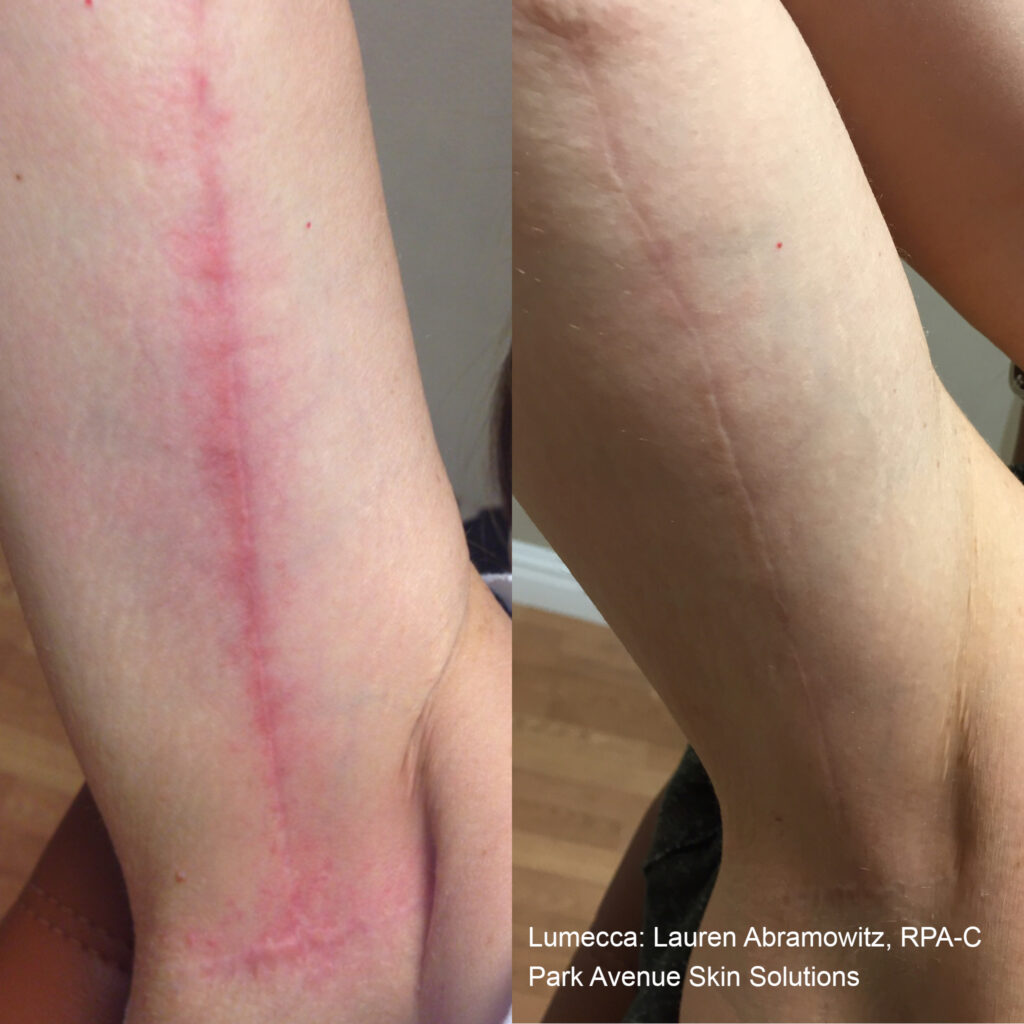IPL Photofacial treatment at Dripology medspa - photo 1