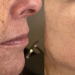 Lumecca IPL treatment at Dripology medspa - photo 4