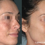 Lumecca IPL treatment at Dripology medspa - photo 5
