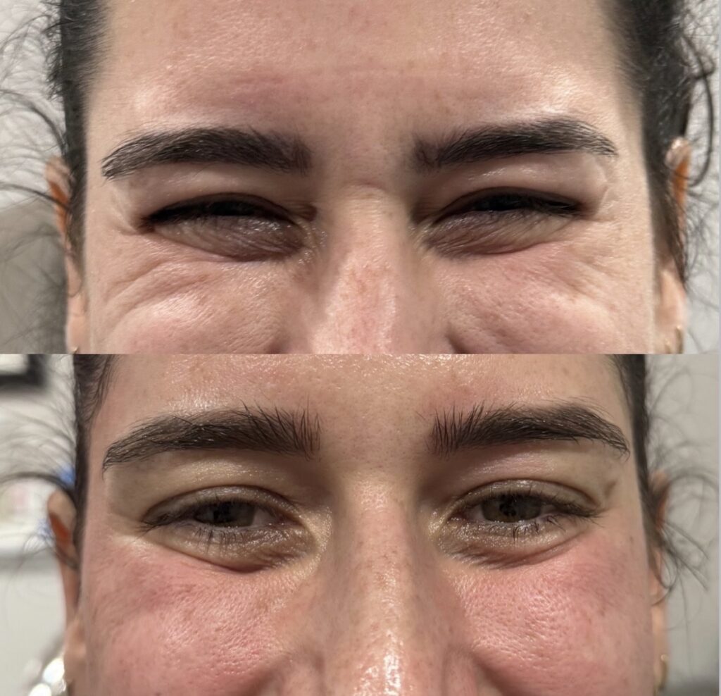 Botox Dysport treatment - Dripology