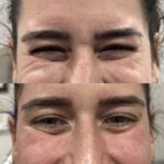 Botox Dysport treatment - Dripology