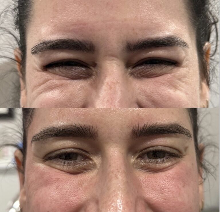 Botox Dysport treatment - Dripology