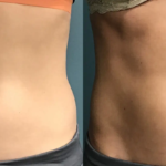 EvolveX body contouring at Dripology medspa - photo 2