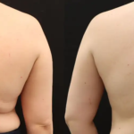 EvolveX body contouring at Dripology medspa - photo 4