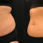 EvolveX body contouring at Dripology medspa - photo 5