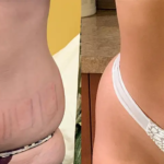 EvolveX body contouring at Dripology medspa - photo 7