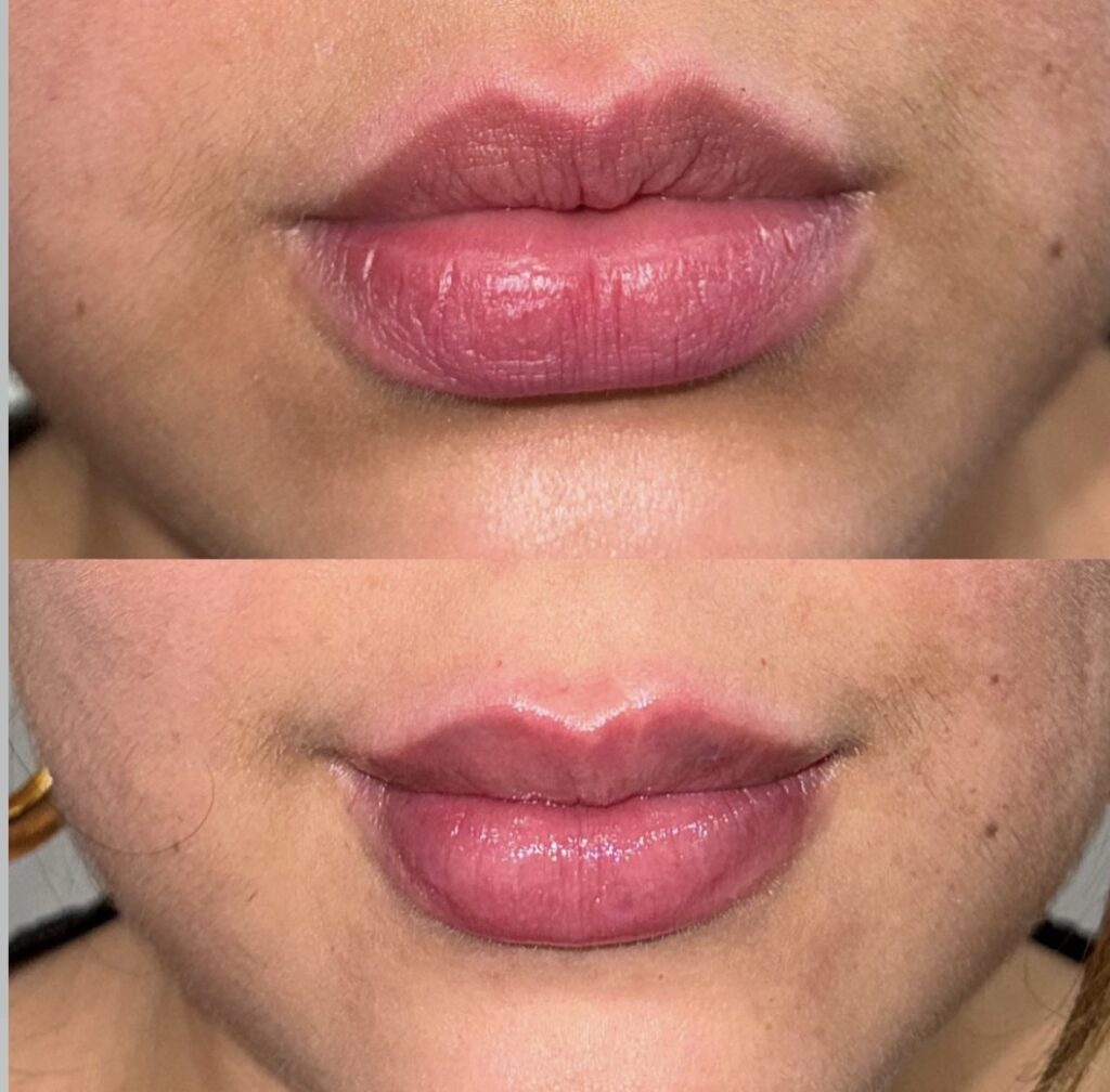 Dermal filler treatment - Dripology