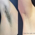 Laser hair removal treatment at Dripology - photo 2
