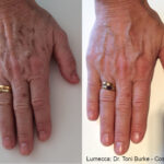 Lumecca IPL treatment at Dripology medspa - photo 2