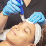 microneedling