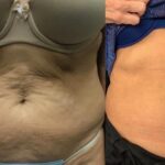 Morpheus8 body contouring results at Dripology - photo 1