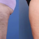 Morpheus8 body contouring results at Dripology - photo 2