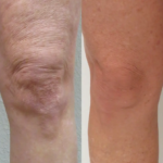 Morpheus8 body contouring results at Dripology - photo 3