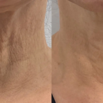 Morpheus8 facial treatment results at Dripology - photo 1