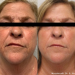 Morpheus8 facial treatment results at Dripology - photo 0