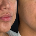 Morpheus8 facial treatment results at Dripology - photo 3