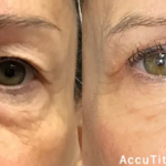 Morpheus8 facial treatment results at Dripology - photo 5