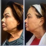 Morpheus8 facial treatment results at Dripology