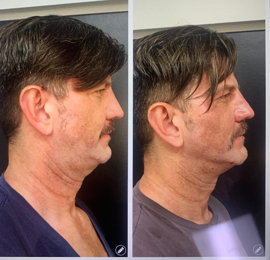 RF microneedling facial treatment results at Dripology