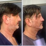 Morpheus8 facial treatment results at Dripology