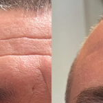 Morpheus8 facial treatment results at Dripology - photo 8