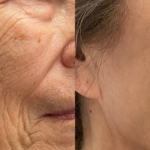 Morpheus8 facial treatment results at Dripology - photo 9