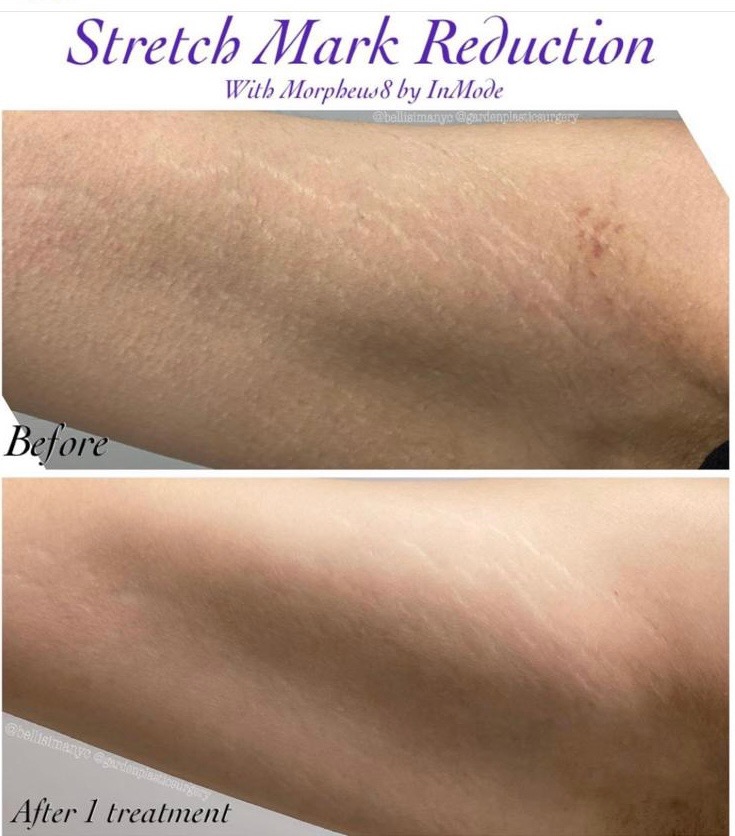 Morpheus8 RF microneedling - Dripology