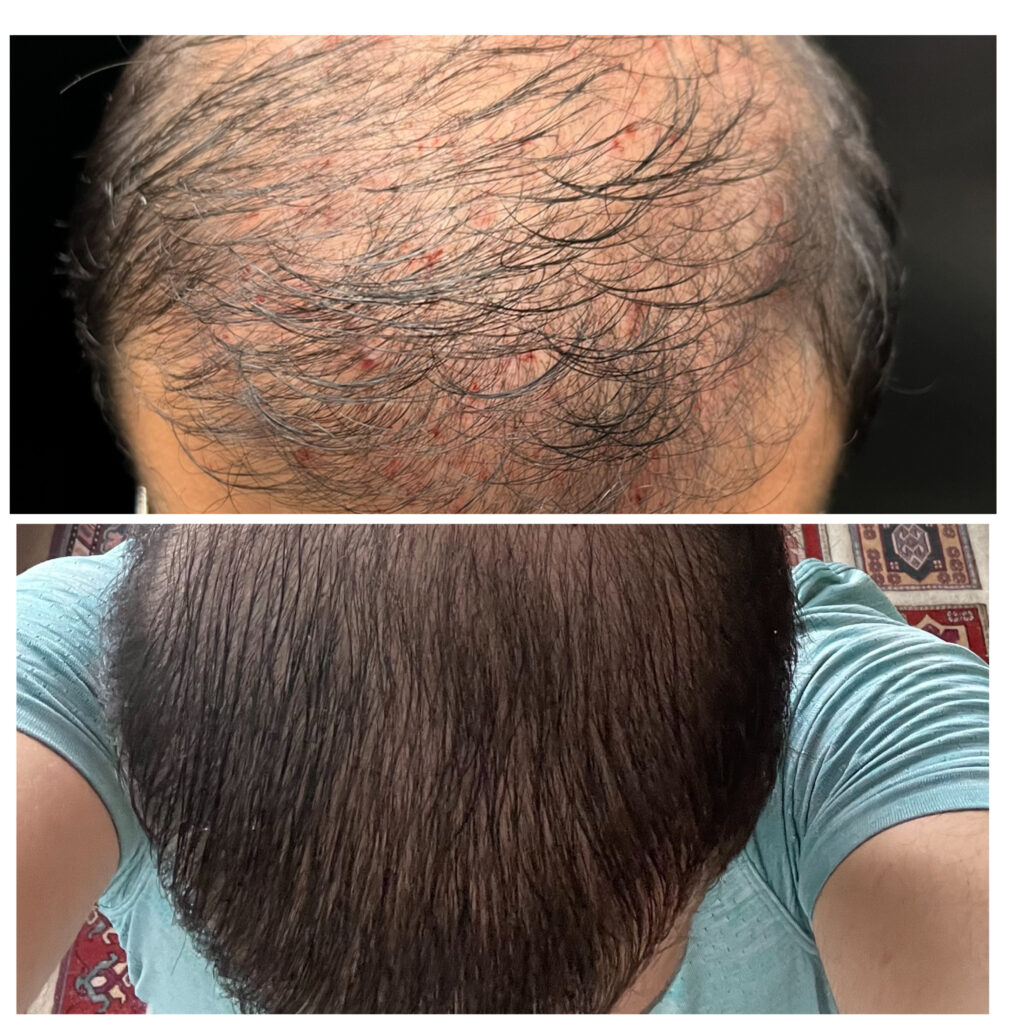 PRP facial treatment - Dripology