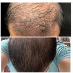 PRP facial treatment - Dripology