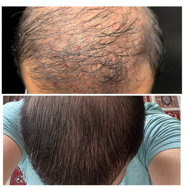 PRP facial treatment - Dripology