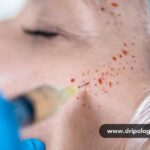 PRP facial treatment at Dripology medspa - photo 1