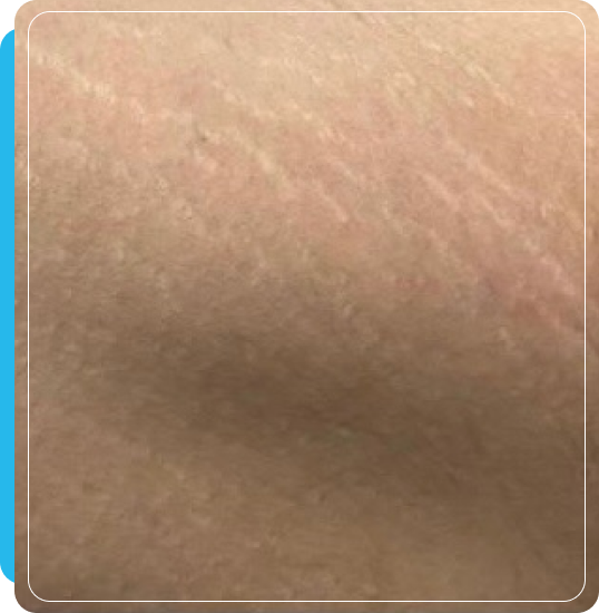 Vein Reduction vein treatment at Dripology medspa - photo 2